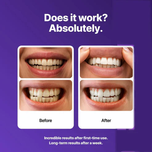 ✨ 14 Strips - Purple Teeth Whitening Strips (Gen 2) - 8x Brighter Smile