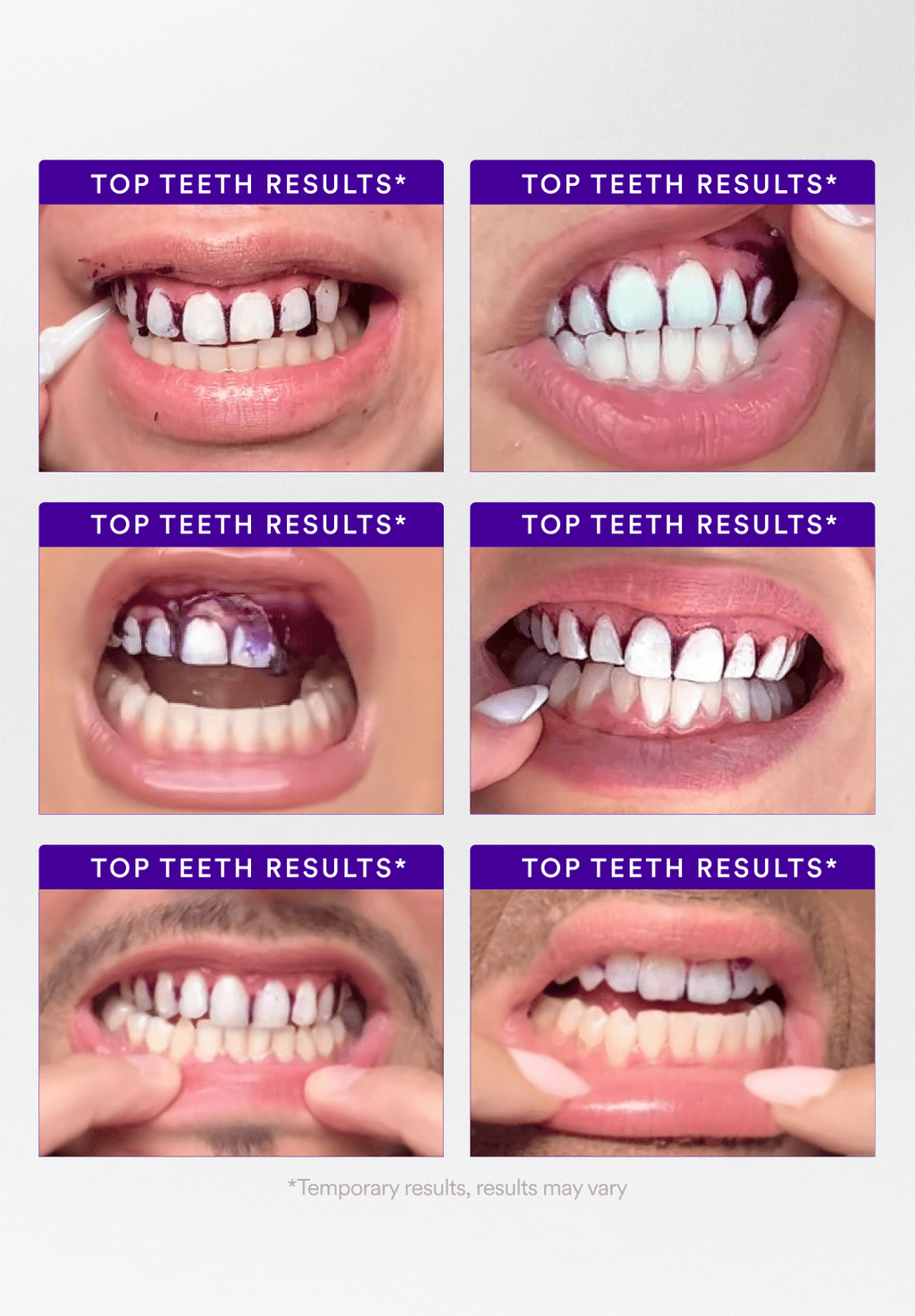 Hismile V34 Whitening Strips- 8x Brighter Smile, Enamel Safe, Non-Sensitive