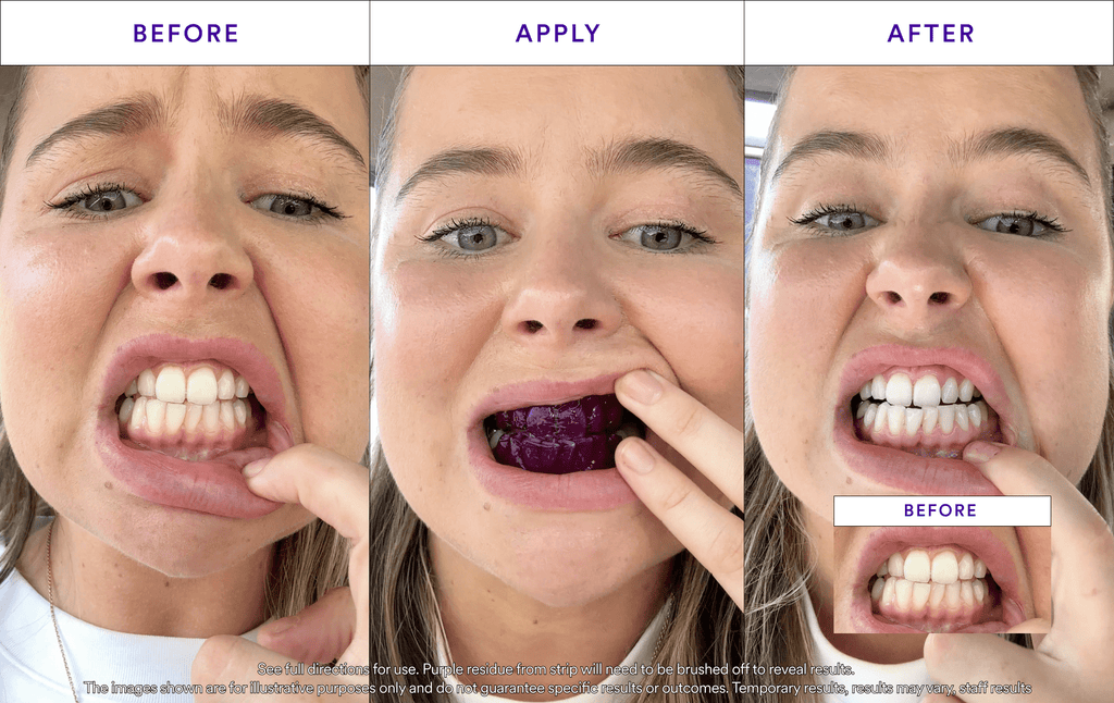 Hismile V34 Whitening Strips- 8x Brighter Smile, Enamel Safe, Non-Sensitive