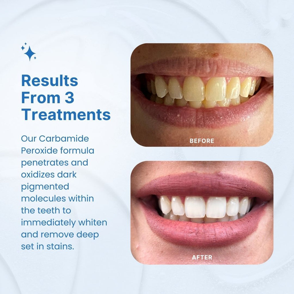 PurelyWHITE Teeth Whitening Kit |Advanced 10XLED Light, Instant Whitening, Oral Stain Remover For Sensitive Teeth