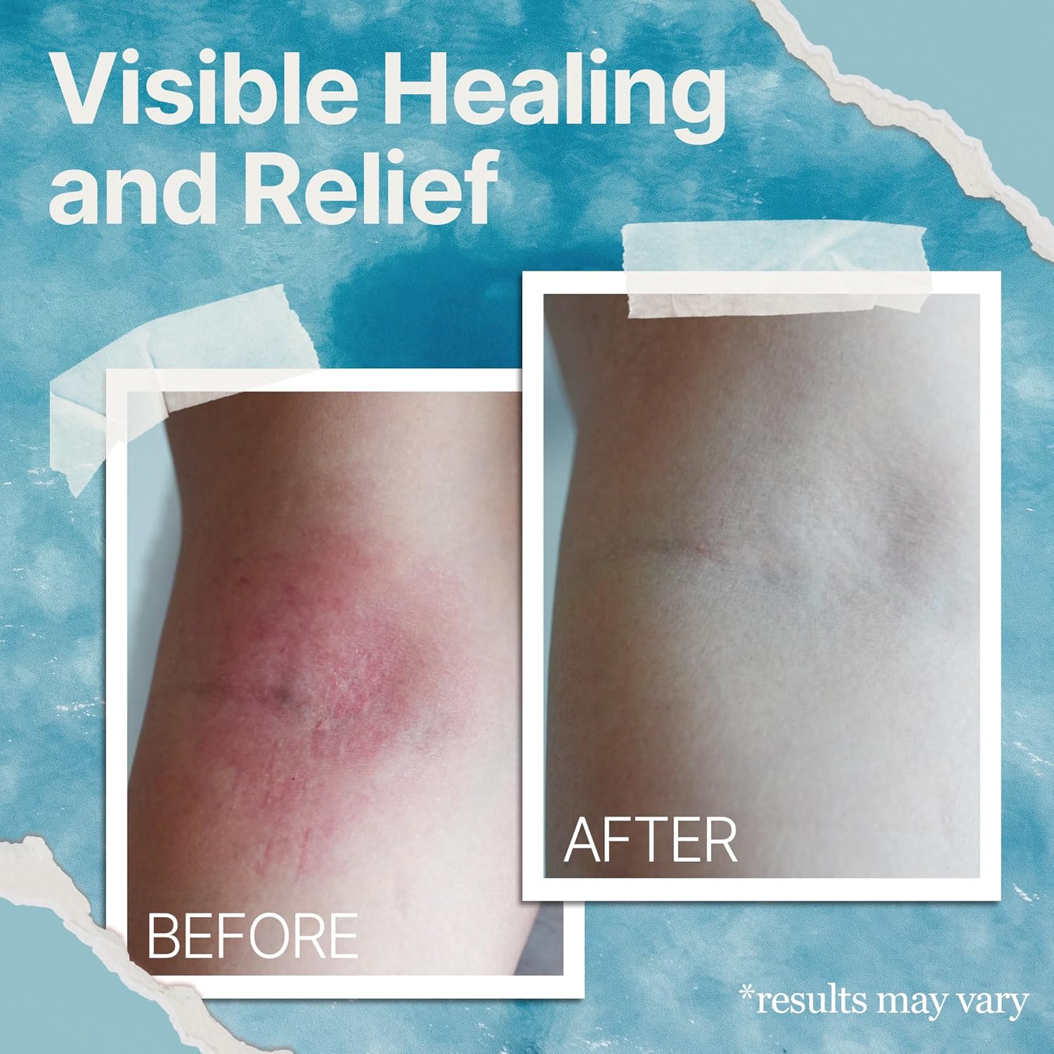 Natural Eczema & Psoriasis Cream with Sea Moss & Colloidal Oatmeal for Itch Relief (4oz)
