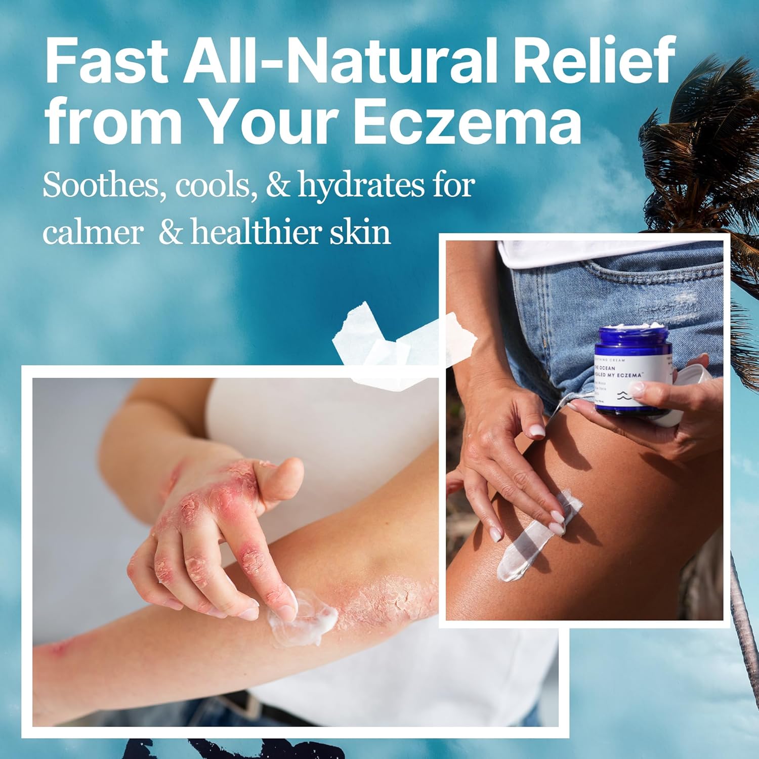 Natural Eczema & Psoriasis Cream with Sea Moss & Colloidal Oatmeal for Itch Relief (4oz)